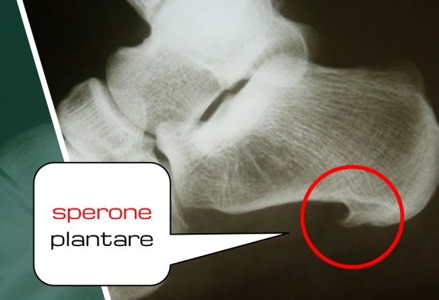 spina-calcaneare