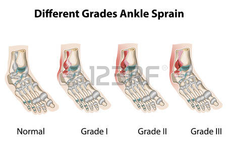 39495351-gradi-di-distorsioni-della-caviglia