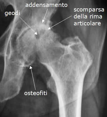 Rx anca artrosica