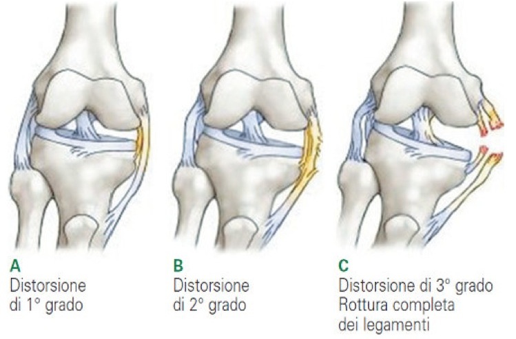 distorsioni-ginocchio