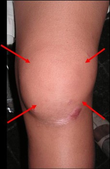 knee-swelling-228x348