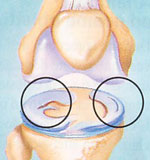 lesioni_menisc