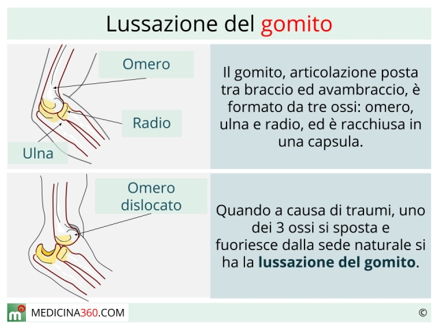 lussazione-gomito_640x480