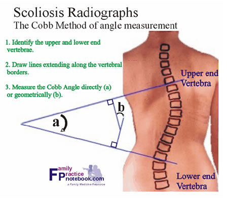 scoliosis