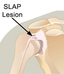slap-lesion